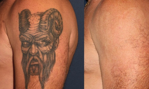 braço com tatuagem removida a laser no Rio de Janeiro