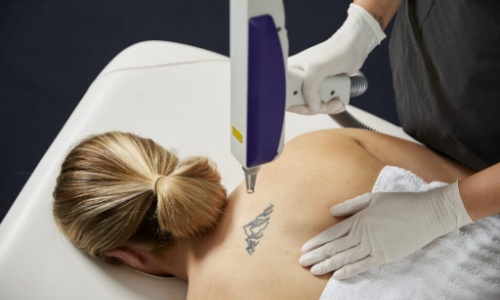 mulher deitada removendo tatuagem nas costas